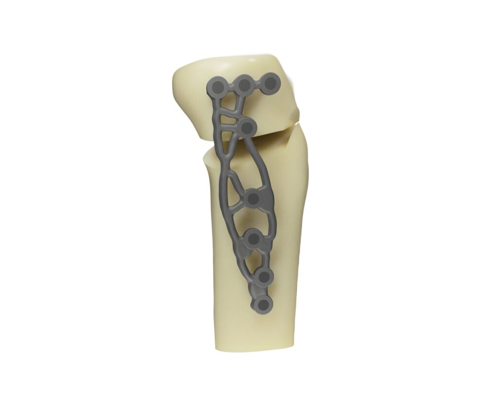 Rendering of generatively designed high tibial osteotomy fixation plate designed.